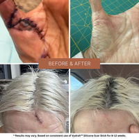 Vydrah™ Silicone Scar Stick