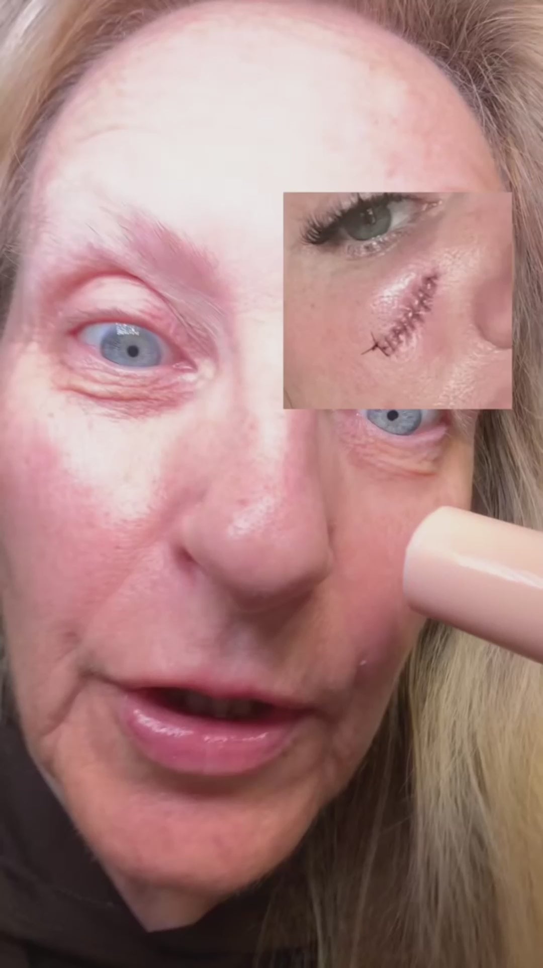 Vydrah™ Silicone Scar Stick video